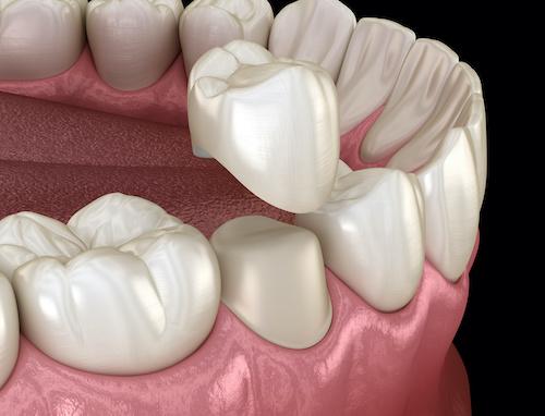 crown on teeth
