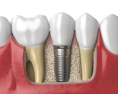 bone grafting in grand island ne