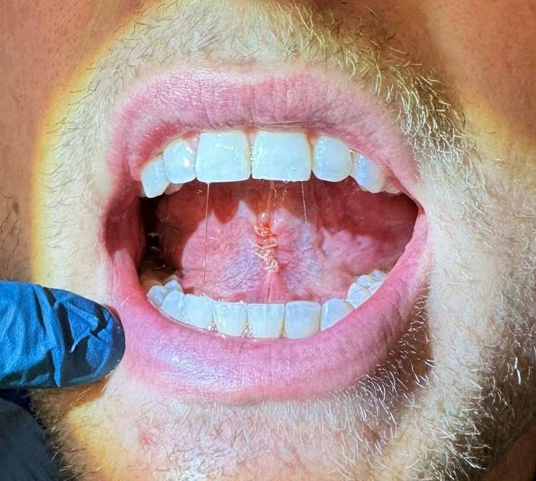 Adult-Lip-and-Tongue-Tie-Revisions-After-Image