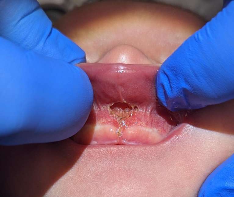 Infant-Lip-and-Tongue-Tie-Revisions-After-Image