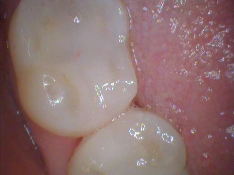 Safe-Mercury-Amalgam-Removal-Technique-After-Image