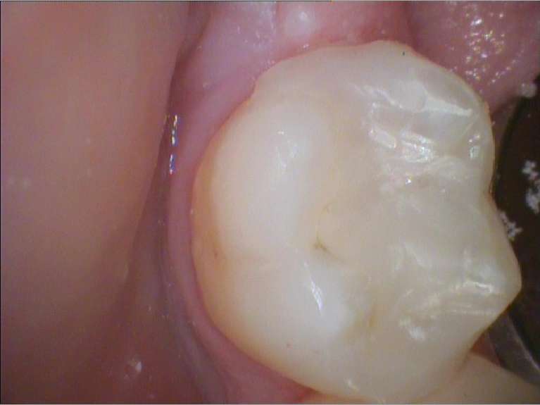 Safe-Mercury-Amalgam-Removal-Technique-After-Image