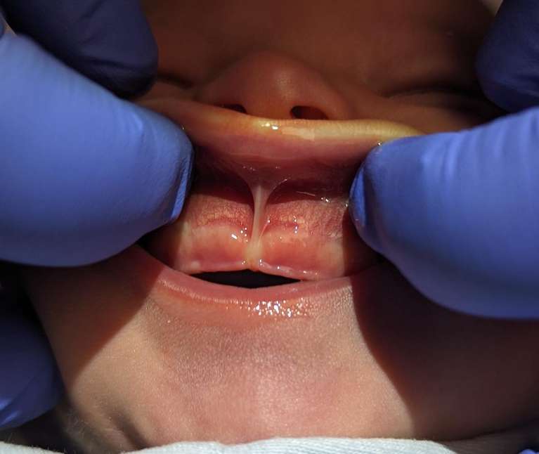 Infant-Lip-and-Tongue-Tie-Revisions-Before-Image