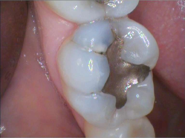 Safe-Mercury-Amalgam-Removal-Technique-Before-Image