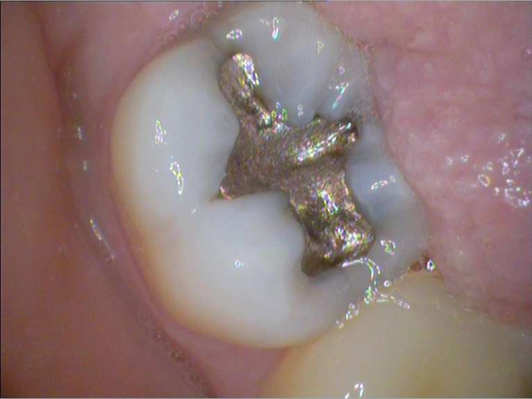 Safe-Mercury-Amalgam-Removal-Technique-Before-Image