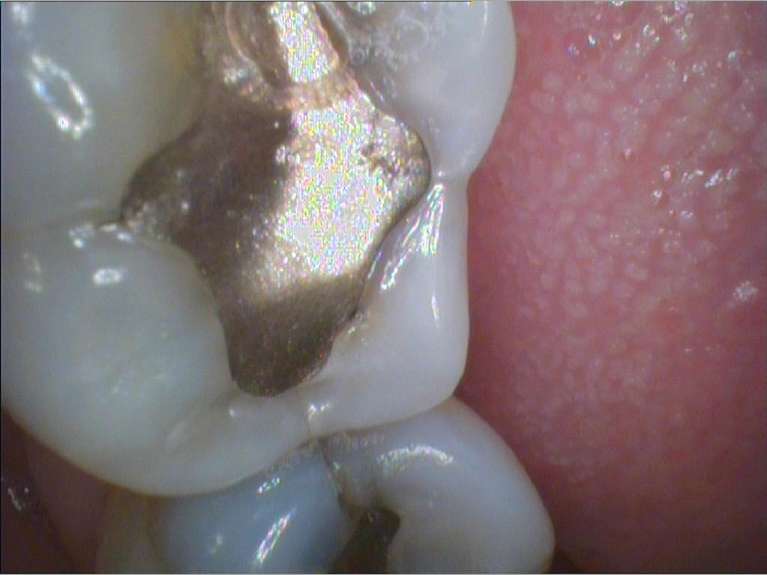 silver amalgam in tooth