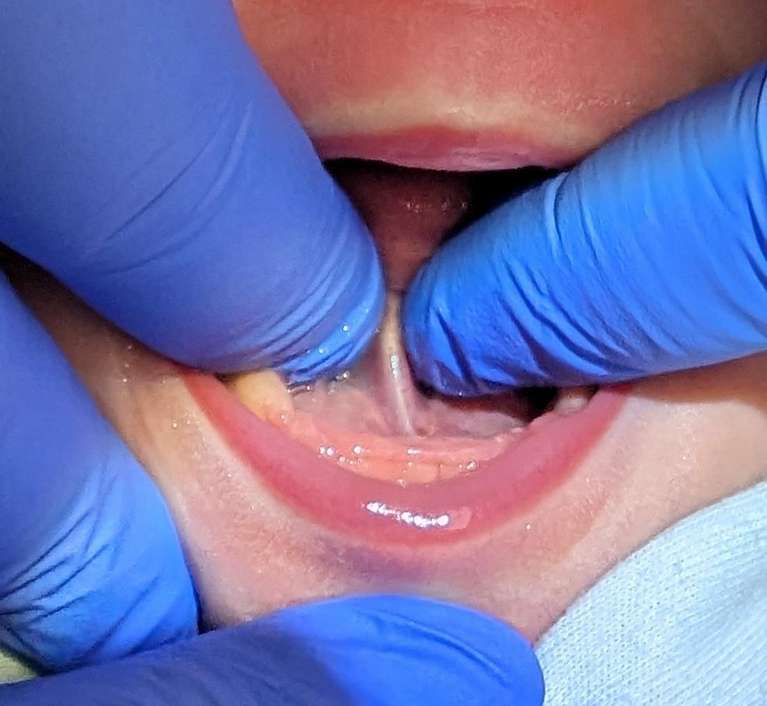 appearance before the tongue-tie procedure