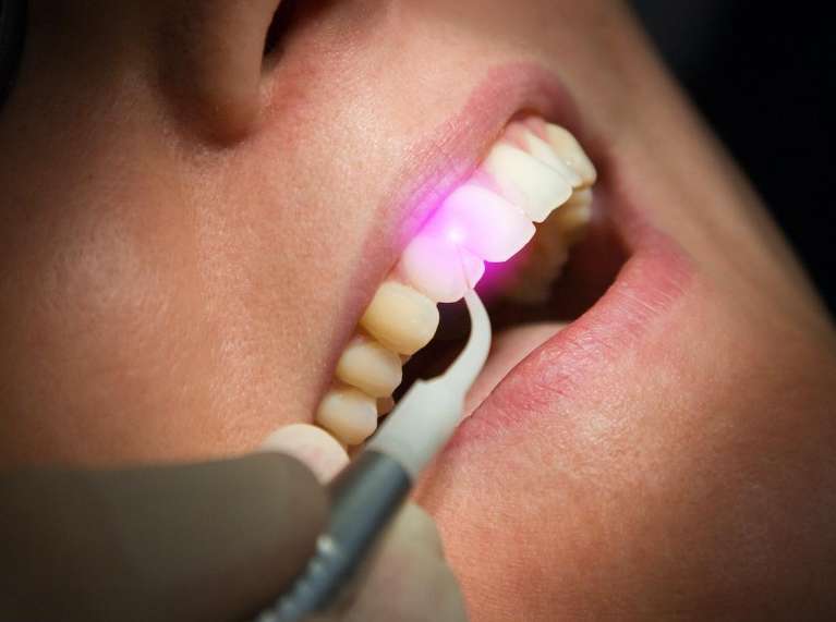laser dentistry on teeth